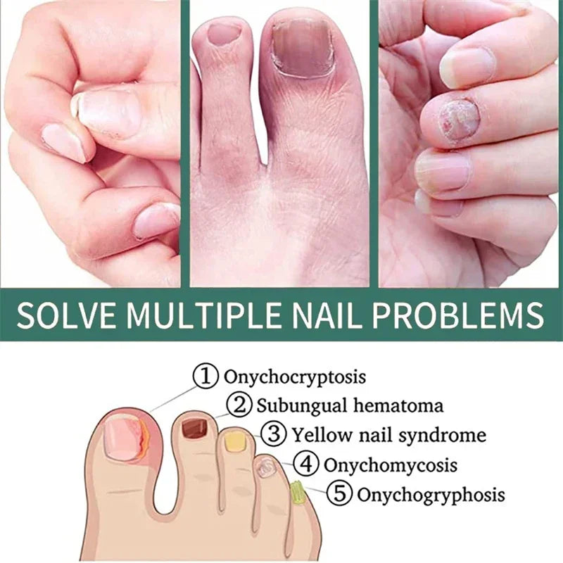 Nail Fungus Defender Serum
