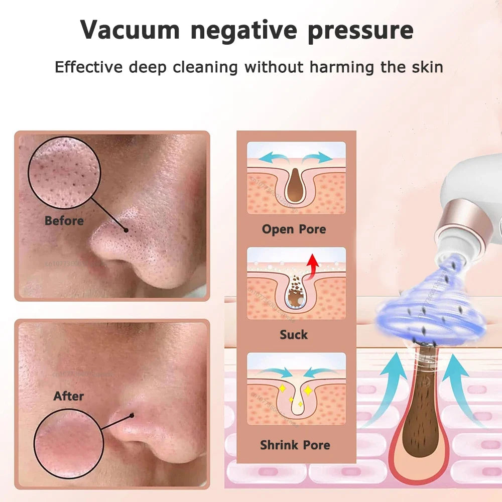 Acne Black Head Deep Clean Removal
